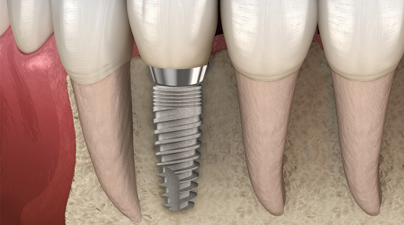 Osseointegration