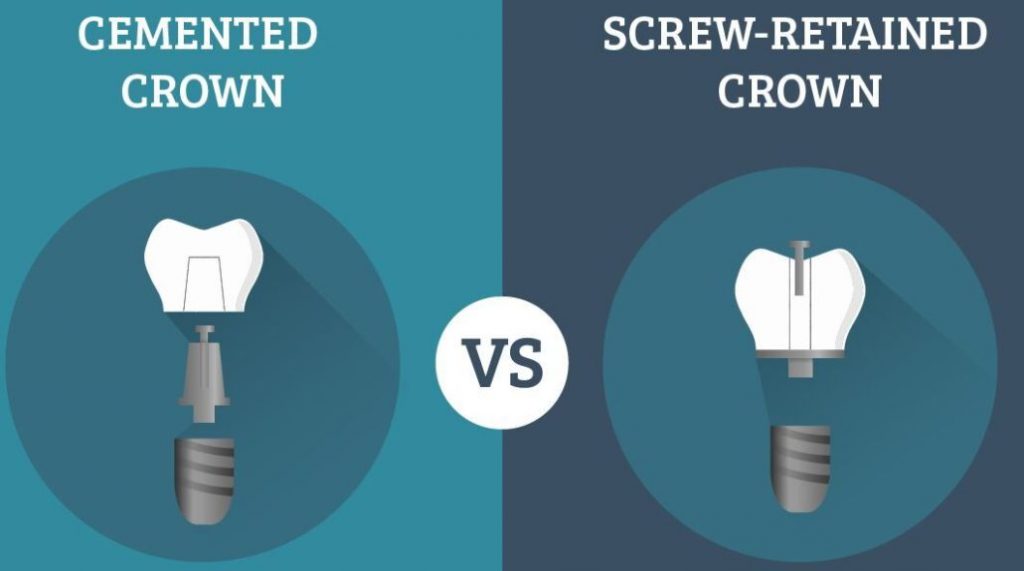 Screw-vs-Cement